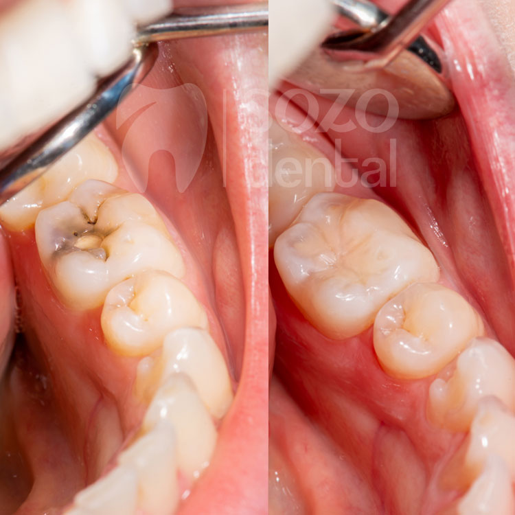 dokter gigi terdekat - tambal gigi