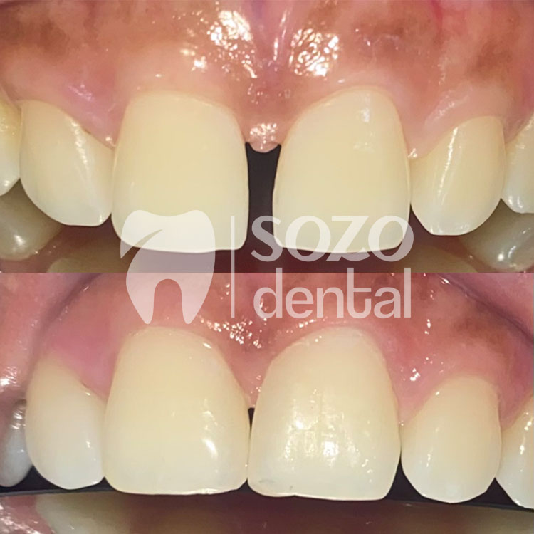 dokter gigi terdekat - veneer gigi